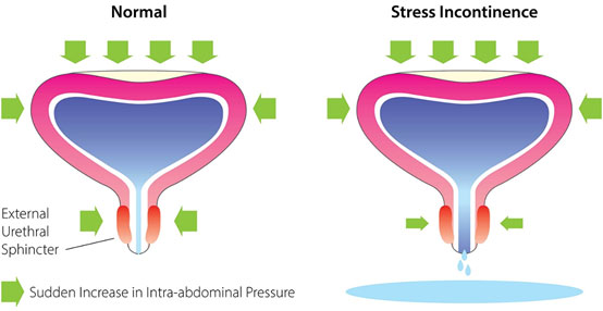 Stresova-inkontinence-schema