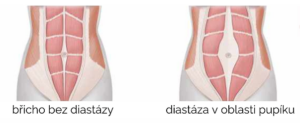 Diastáza 2